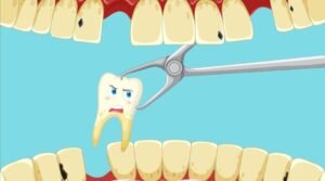 Why Delaying Tooth Extraction Can Cause Bigger Problems in Falls Church